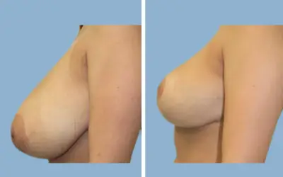 Before and After
